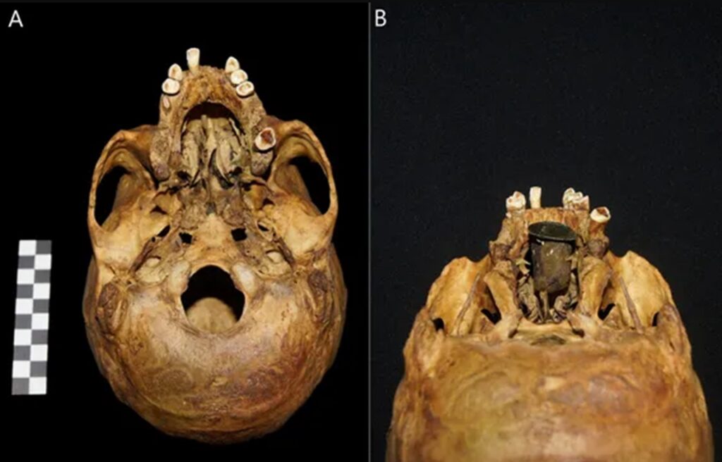 palatoschisi cranio uomo morto XVIII secolo