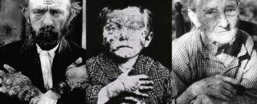 pellagra foto malattia