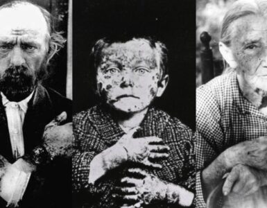 pellagra foto malattia