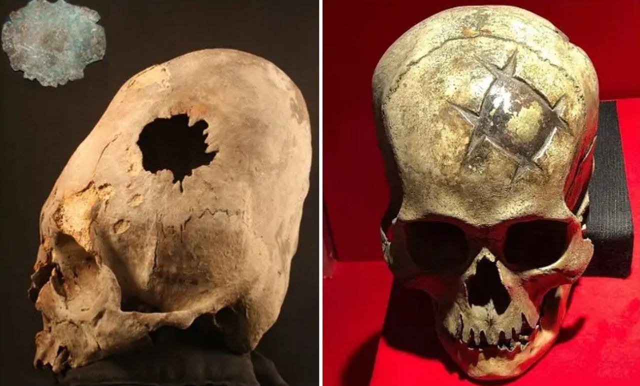 civiltà precolombiane chirurgia cranica