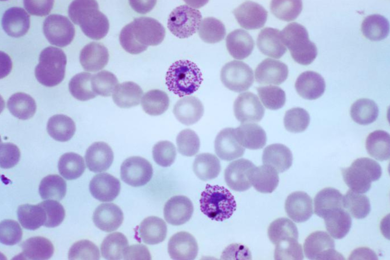 Malaria Plasmodium vivax